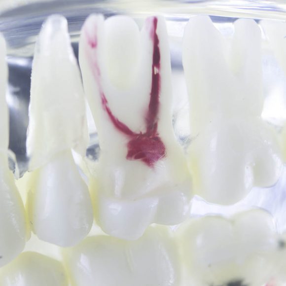 Endodontie / Wurzelbehandlung